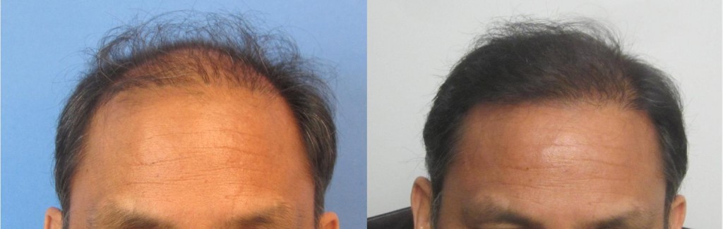 Los Angeles Hair transplant